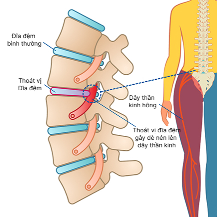 Thoát vị đĩa đệm